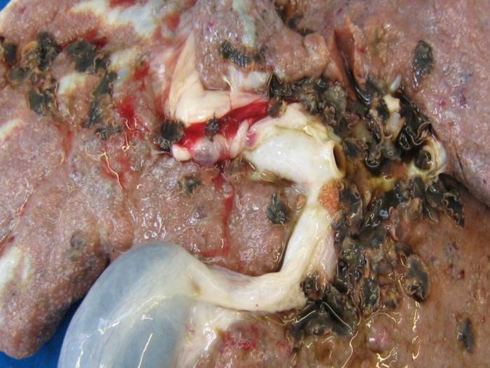 A liver affected by chronic fluke, with adult flukes visible.