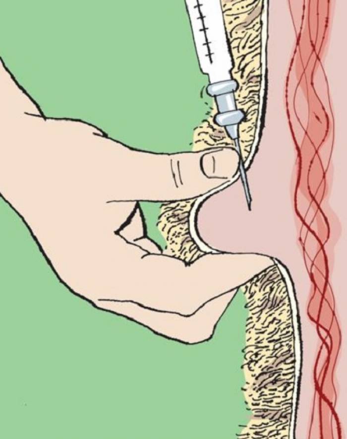 For a subcutaneous injection, pinch a fold of skin inject into the 'cushion' of skin.