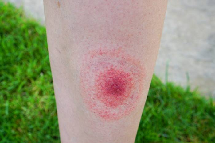 Ticks bites in humans can cause Lyme disease - visit the NHS website for more details.